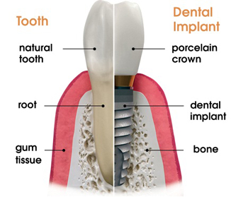 Dental Implant Comparison to a Natural Tooth