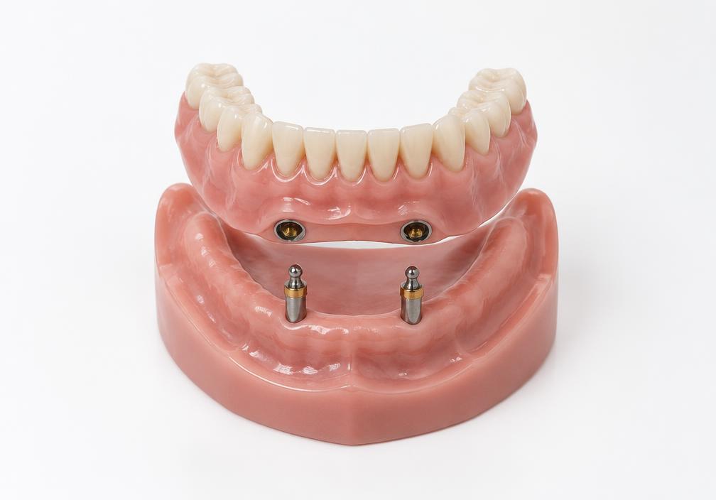 Clinical illustration of snap-in overdentures