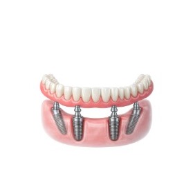 All-On-4 Dental Implants illustration