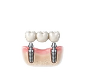 Implant Bridges illustration