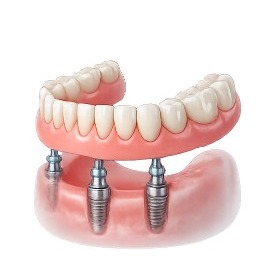 Implant-Supported Dentures illustration