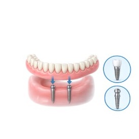 Mini Dental Implants illustration