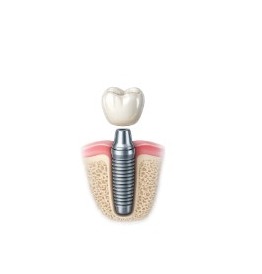 Single-Tooth Implant illustration