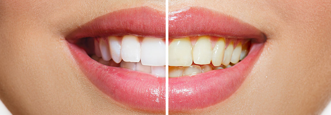 Comparing Before and After Smile From Teeth Whitening