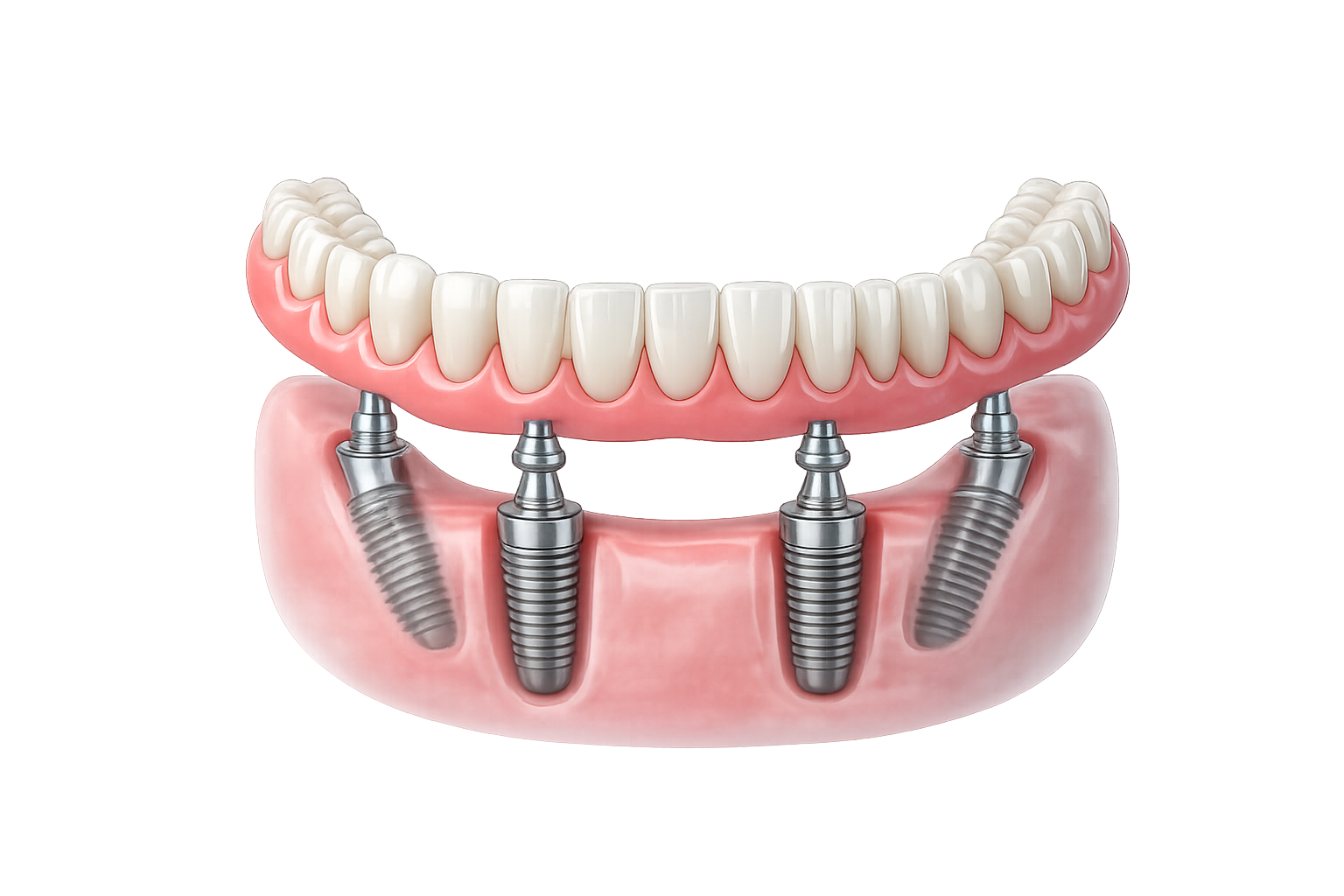 All-on-4 dental implants illustration