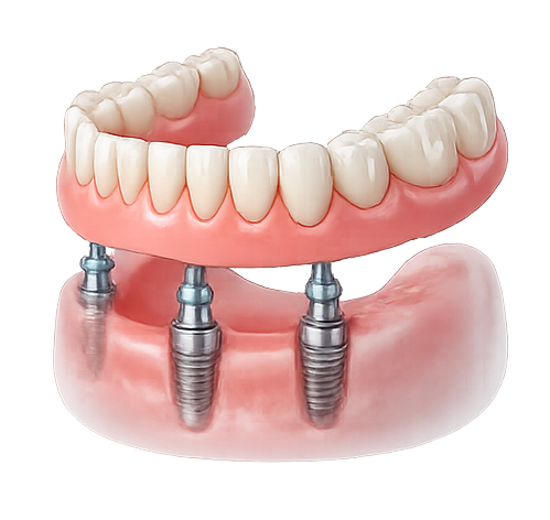 Implant-supported dentures illustration