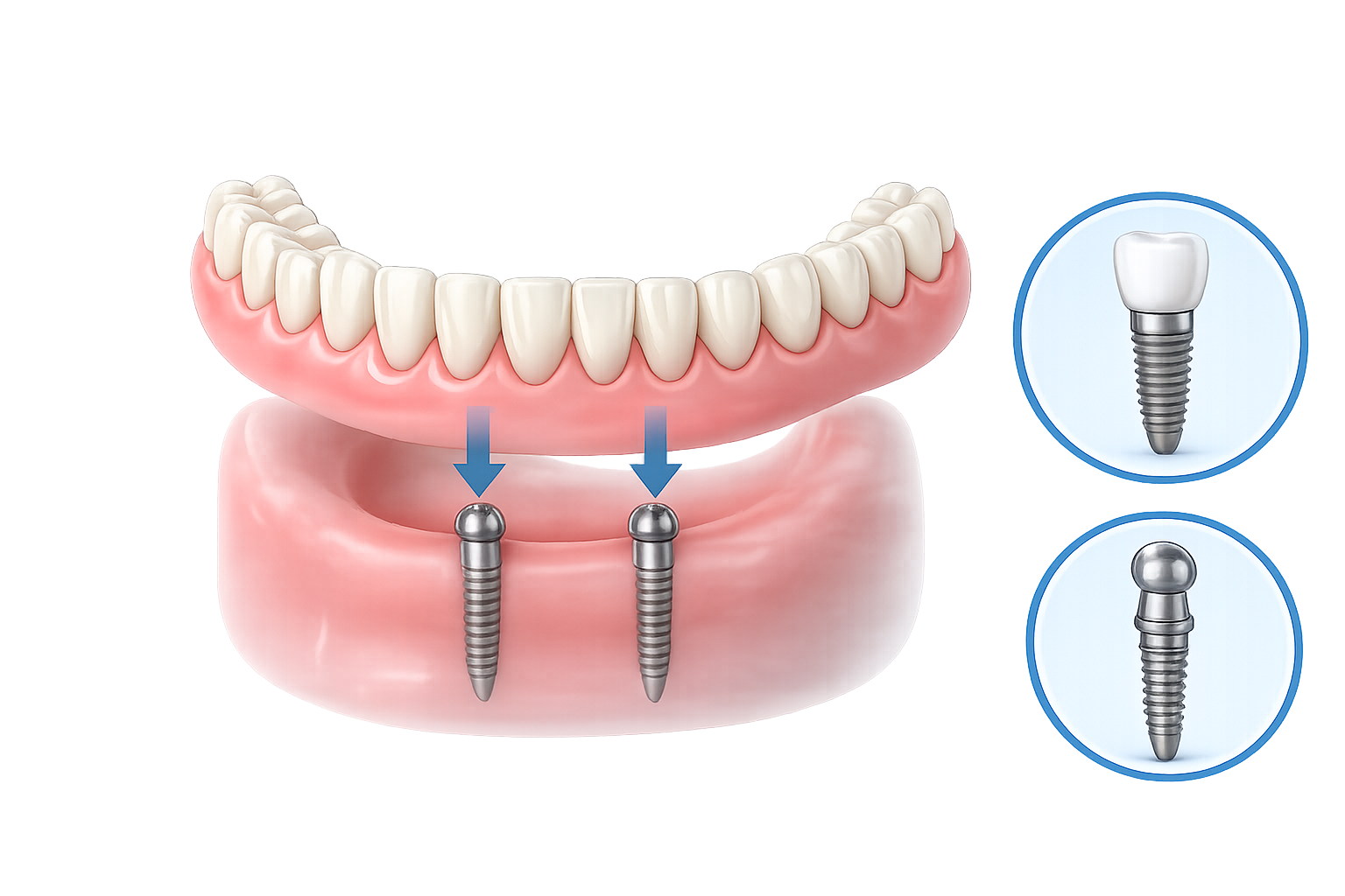 Mini dental implants illustration